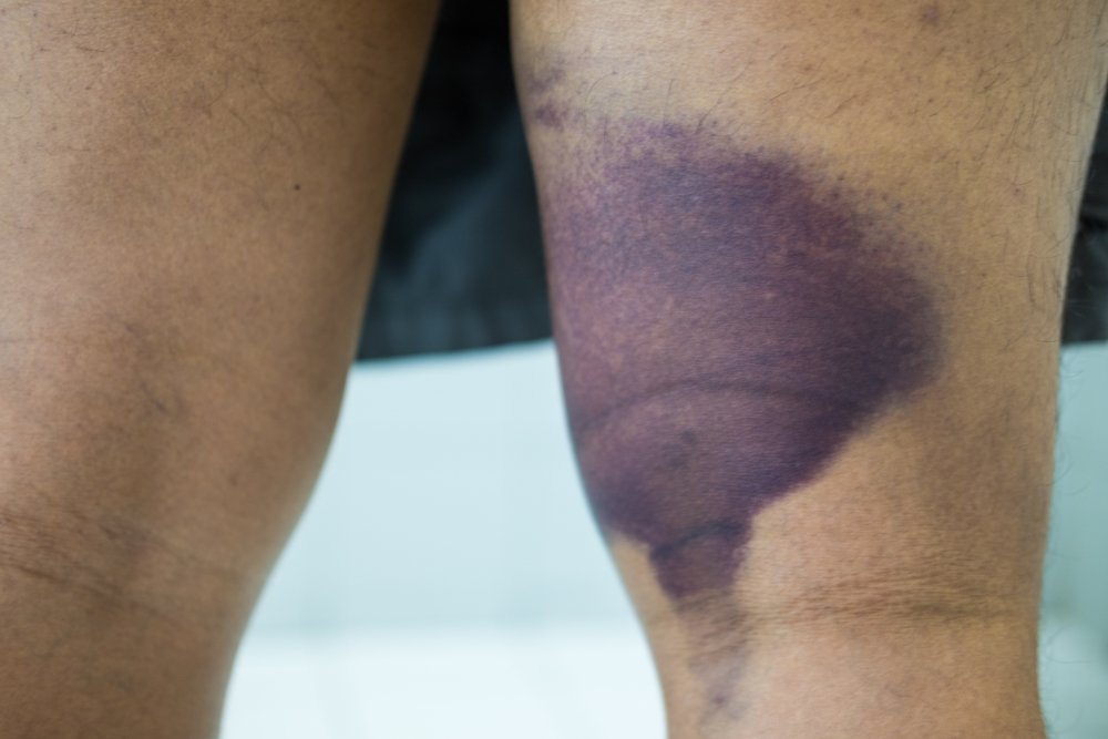 A large, dark purple bruise on the knee and inner thigh of a brown-skinned man