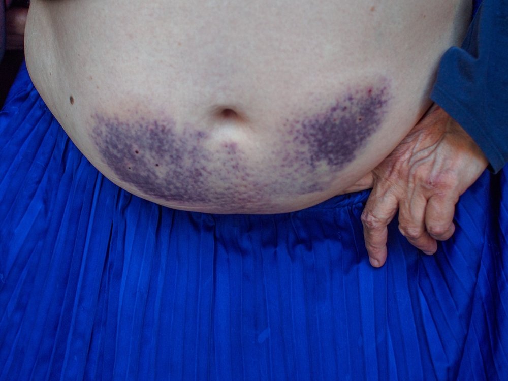 Large purple bruises on the tummy of a white woman