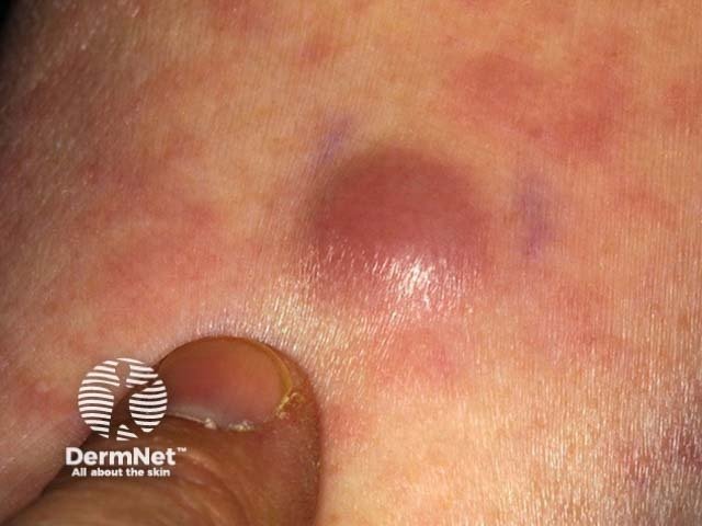 Close up of a smooth, reddish raised bump on white skin. It is about the size of a fingernail.
