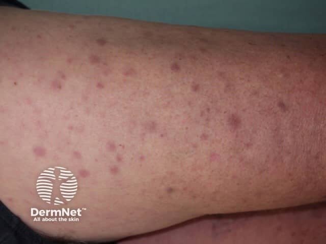 Close up of a white-skinned limb showing a widespread rash of small, flat pinkish-red patches