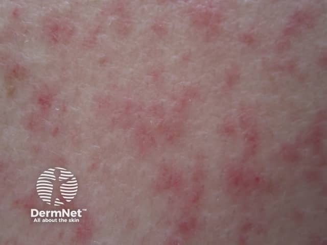 Close up of an area of white skin showing a rash of blotchy reddish-pink patches