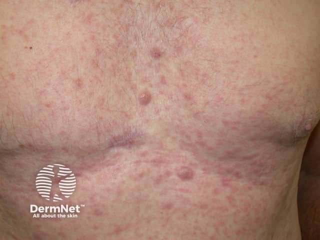 Close up of the chest of a white-skinned man showing a widespread rash of multiple small, raised, pinkish bumps