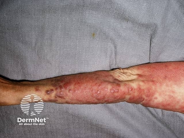 A white-skinned arm covered in a raised, dark red, scaly rash