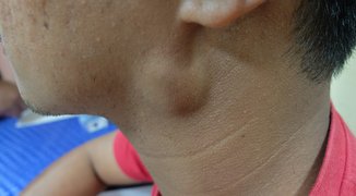 Swollen lymph nodes