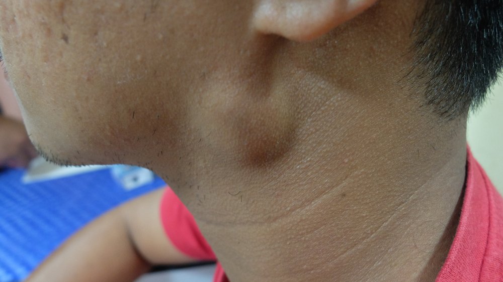 Close up of the neck of a young brown-skinned man with a smooth lump on the left side of his neck, below his jawline. The lump is about 5cm across.