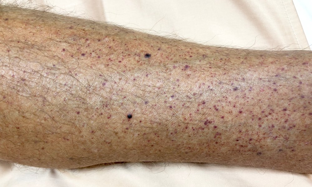 Close up of the leg of a brown-skinned man showing a purple pinprick rash