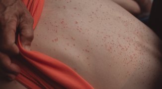 Rash