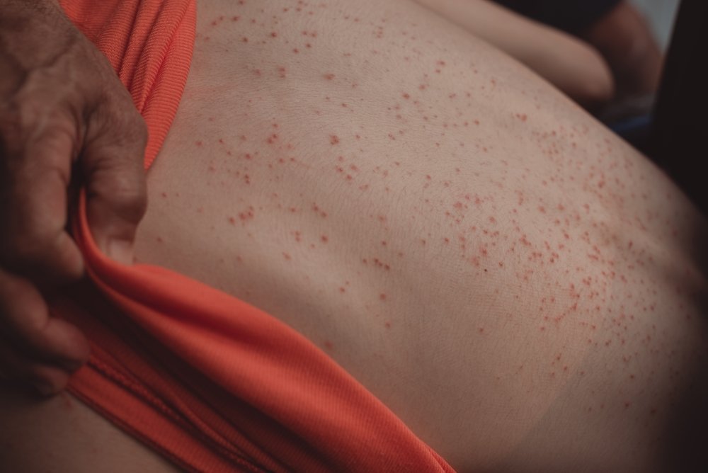 Close up of the back of a white-skinned person showing a reddish pinprick rash