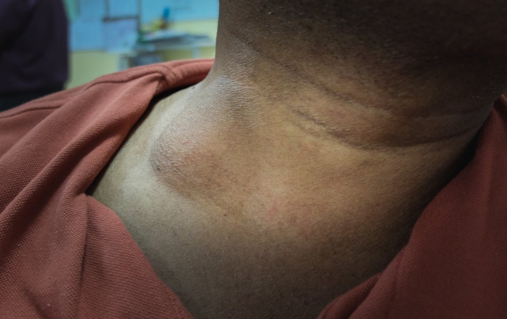 Close up of the neck of a dark-skinned man with a smooth lump on the right side of his neck, above his collar bone. The lump is about 6 to 7 cm across.