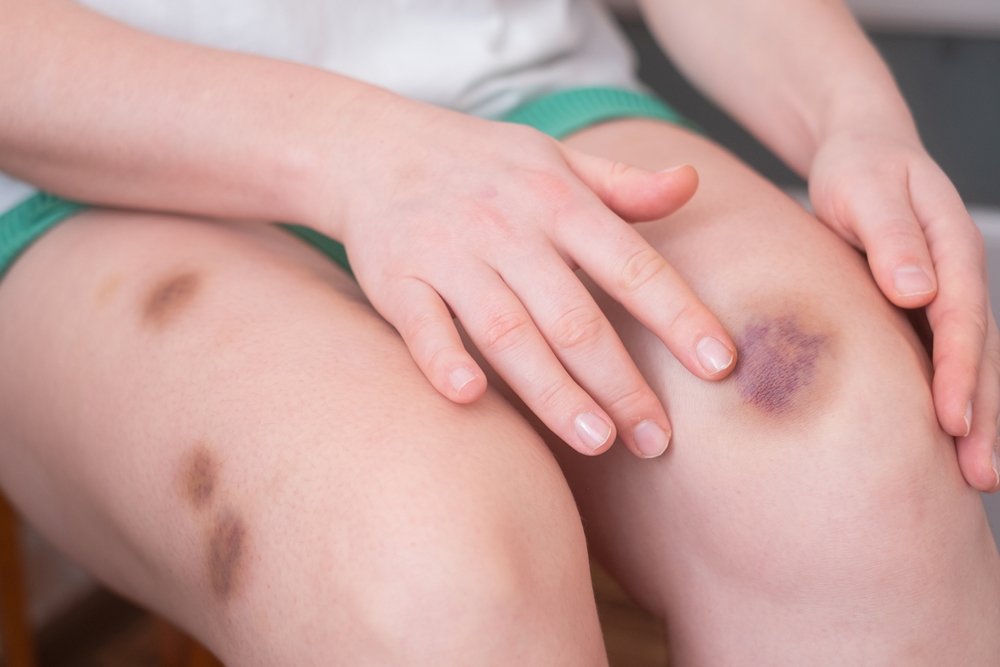 A close up of the upper legs and knees of a young white woman with multiple brown bruises